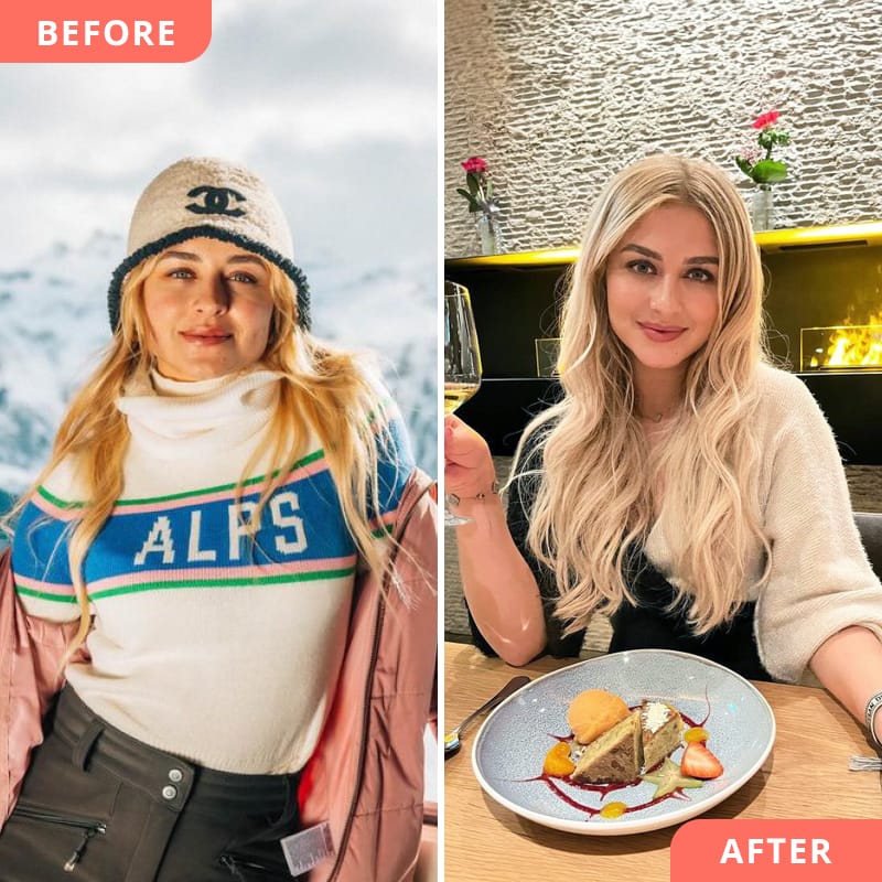 Before and after collage of a masseter treatment with botulinum toxin at Beauty2Go - the result shows a slimmer facial profile due to gentle narrowing of the jaw area and chewing muscle