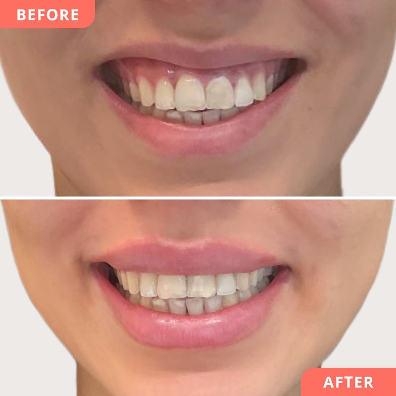 Vorher-Nachher Collage einer Gummy-Smile Behandlung mit Botulinumtoxin bei Beauty2Go – Oberlippe liegt entspannter an, harmonisches Lächeln ohne sichtbares Zahnfleisch