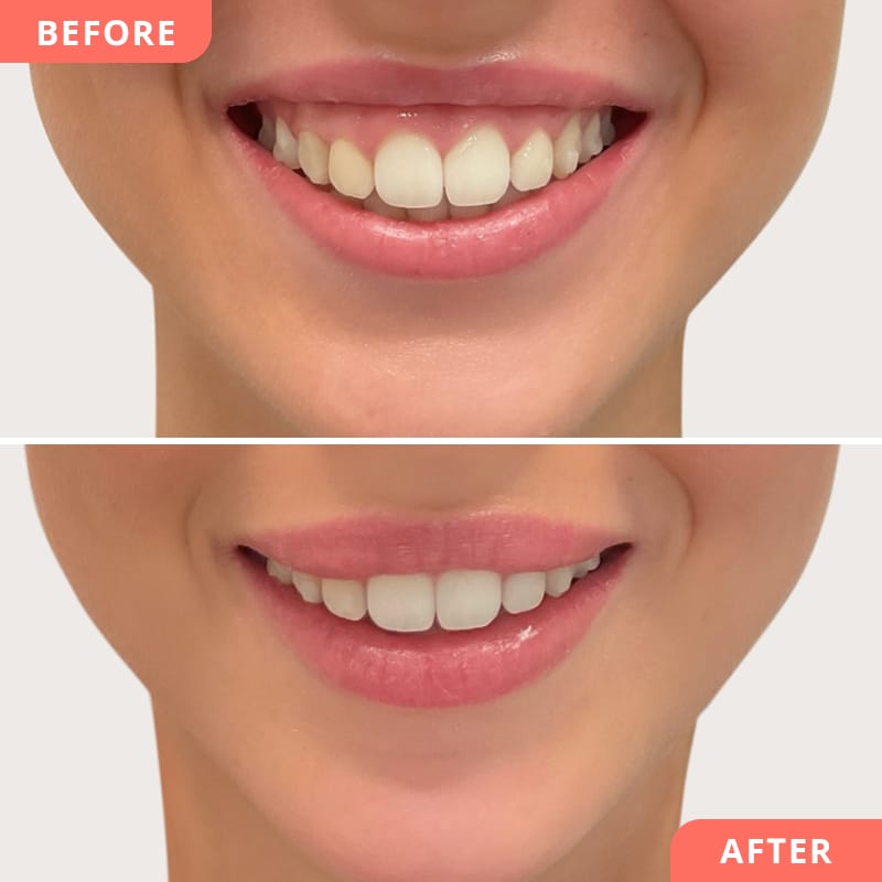 Vorher-Nachher Vergleich einer Botulinumtoxin-Behandlung gegen Gummy-Smile durch minimalinvasive Korrektur - Ergebnis zeigt ausgeglichenes, ästhetisches Gesamtbild beim Lächeln