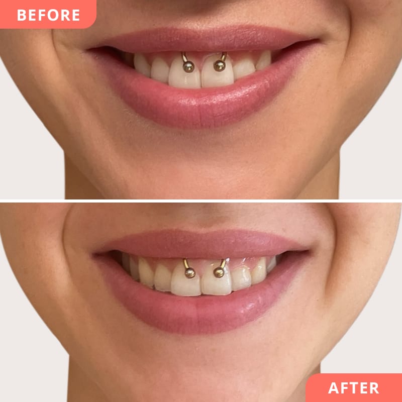 Beauty2Go Vorher-Nachher Bild – Botulinumtoxin Lipflip: Ergebnis zeigt natürliches Lächeln, entspannte Oberlippe und kein Einrollen der Lippe mehr