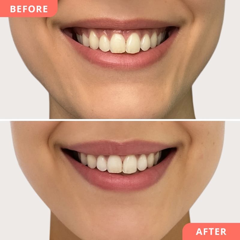 Vorher-Nachher Collage einer Lipflip-Behandlung bei Beauty2Go – Botulinumtoxin entspannt die Oberlippe, das Ergebnis zeigt ein harmonisches, jugendliches Lächeln