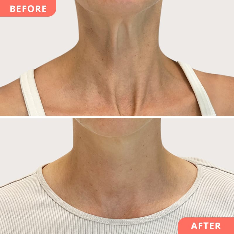 Vorher-Nachher Collage einer Nefertiti-Lift Behandlung mit Botulinumtoxin bei Beauty2Go – dezente Verbesserung der Hals- und Kieferpartie für ein jugendlich-harmonisches Erscheinungsbild