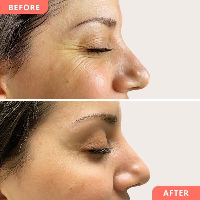 Vorher-Nachher Vergleich einer Botulinumtoxin-Behandlung gegen Krähenfüsse bei Beauty2Go – das Ergebnis zeigt sanfte Glättung der Augenpartie und ein frischeres Erscheinungsbild