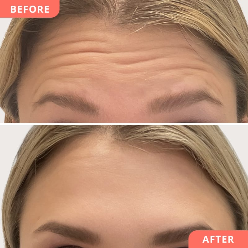 Beauty2Go Vorher-Nachher Bild – Botulinumtoxin-Behandlung der Stirn: das Ergebnis zeigt geglättete Falten, entspannter Gesichtsausdruck und jugendlichere Ausstrahlung