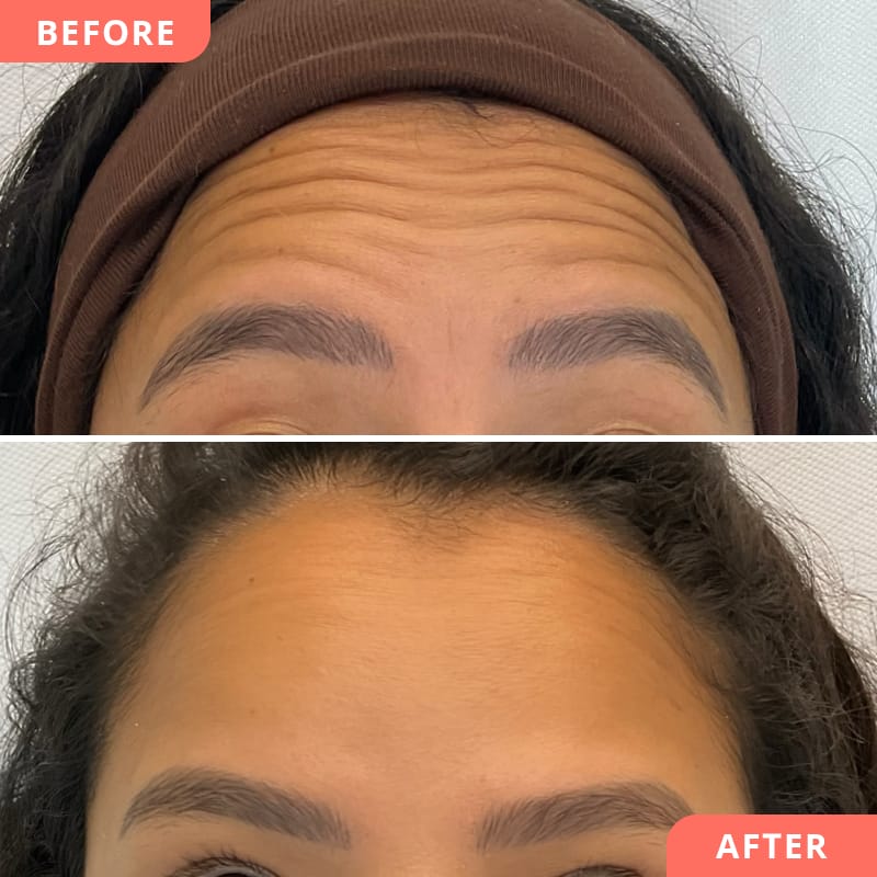 Beauty2Go Vorher-Nachher Bild einer Botulinumtoxin-Behandlung - das Ergebnis zeigt reduzierte Zornesfalte für ein offeneres, harmonisches Gesamtbild
