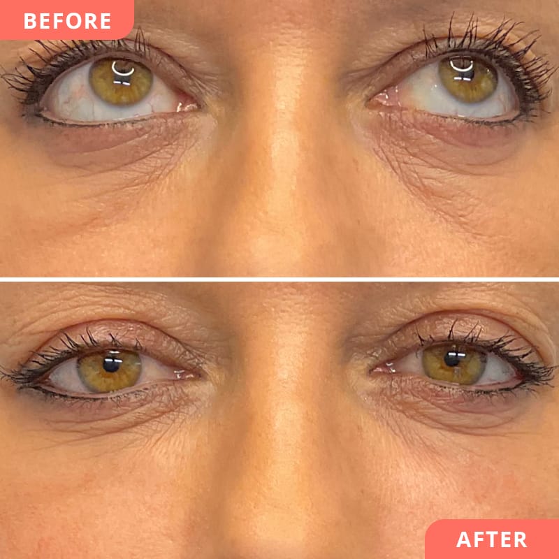 Vorher-Nachher Bild einer Unterspritzung mit Hyaluron bei Beauty2Go – Behandlung glättet Augenfältchen und reduziert dunkle Augenringe