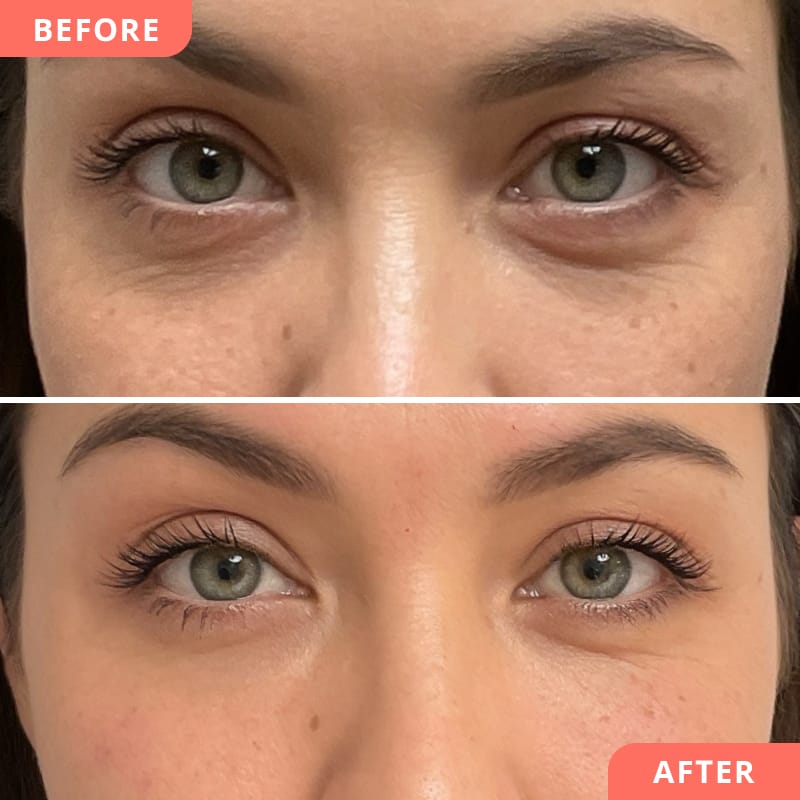 Natürliches Ergebnis nach einer Hyaluron-Behandlung bei Beauty2Go – Vorher-Nachher Collage gegen Augenringe, müde Augen und feine Fältchen