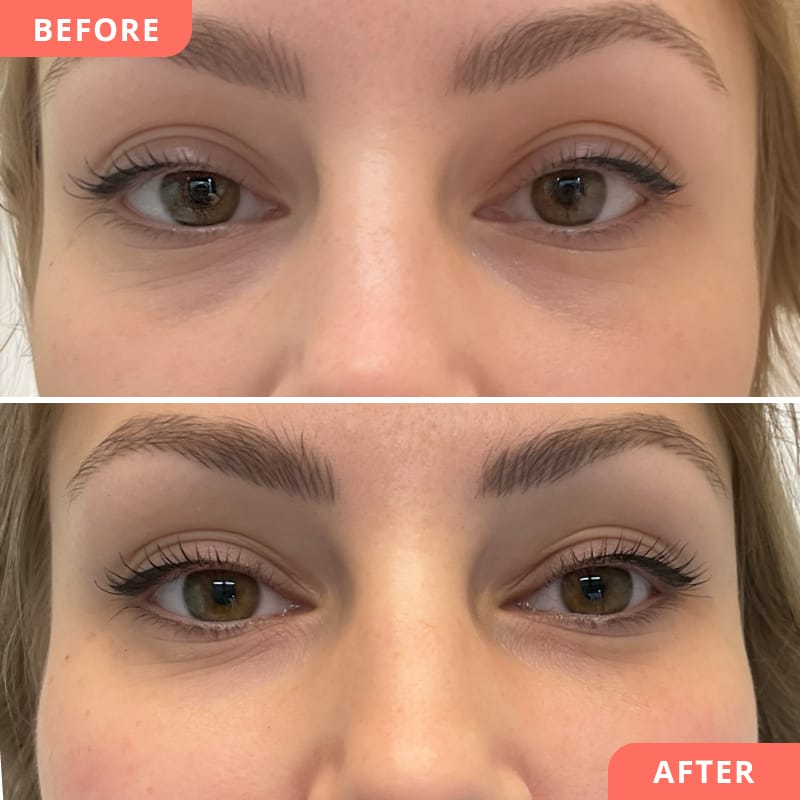 Vorher-Nachher Collage einer Hyaluronsäure-Unterspritzung bei Beauty2Go – Behandlung gegen dunkle Augenringe mit sichtbar frischem und erholtem Blick