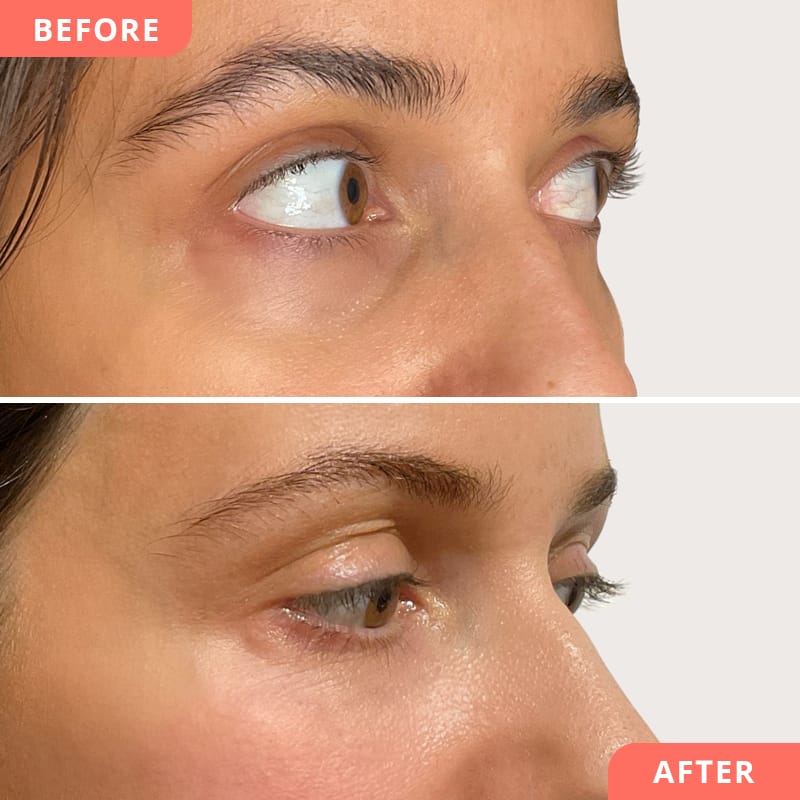 Vorher-Nachher Collage einer Beauty2Go Augenringe Behandlung mit Hyaluron – deutliche Verbesserung eingefallener Augenringe und frischer, jugendlicher Blick