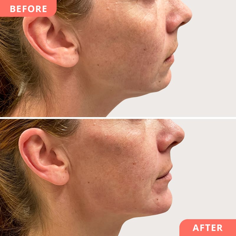 Beauty2Go Vorher-Nachher Bild – Full-Face Liquid Facelift mit Hyaluronsäure für ausgewogene Gesichtsproportionen, natürliche Frische und jugendlichen Glow