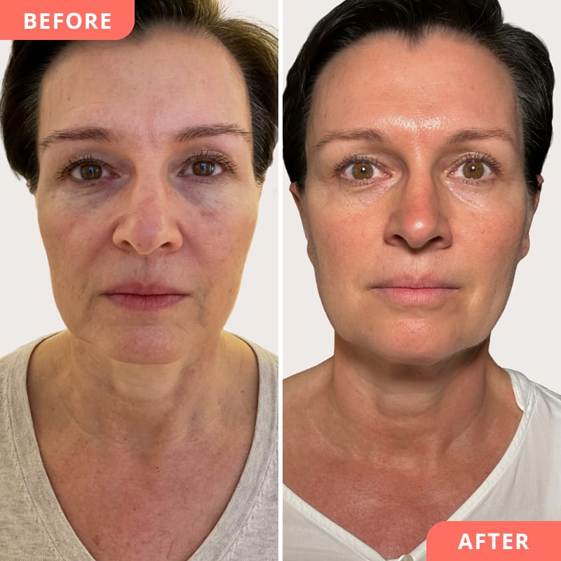 Vorher-Nachher Collage einer Full-Face Liquid Facelift Behandlung mit Hyaluronsäure bei Beauty2Go – frischeres, jugendliches Aussehen und harmonische Symmetrie