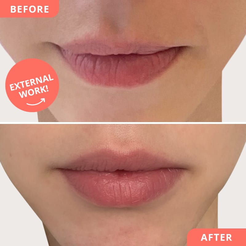 Before and after collage of a Hylase treatment at Beauty2Go - dissolution of old hyaluronic acid and reconstruction for full, natural lips with perfect symmetry