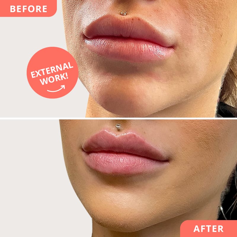 Beauty2Go before and after picture - external correction with Hylase: old hyaluron dissolved, then remodeled with hyaluronic acid for harmonious, full lips