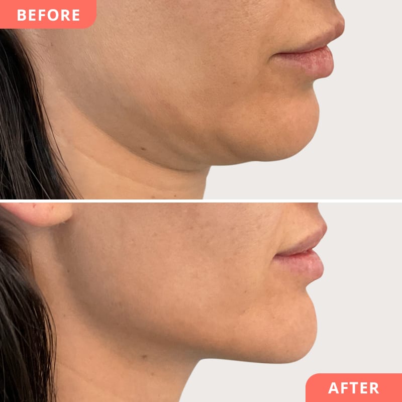 Vorher-Nachher Vergleich einer Hyaluron-Jawline Korrektur – definierte Kieferlinie, jugendliches Profil und ausgewogenes Gesamtbild