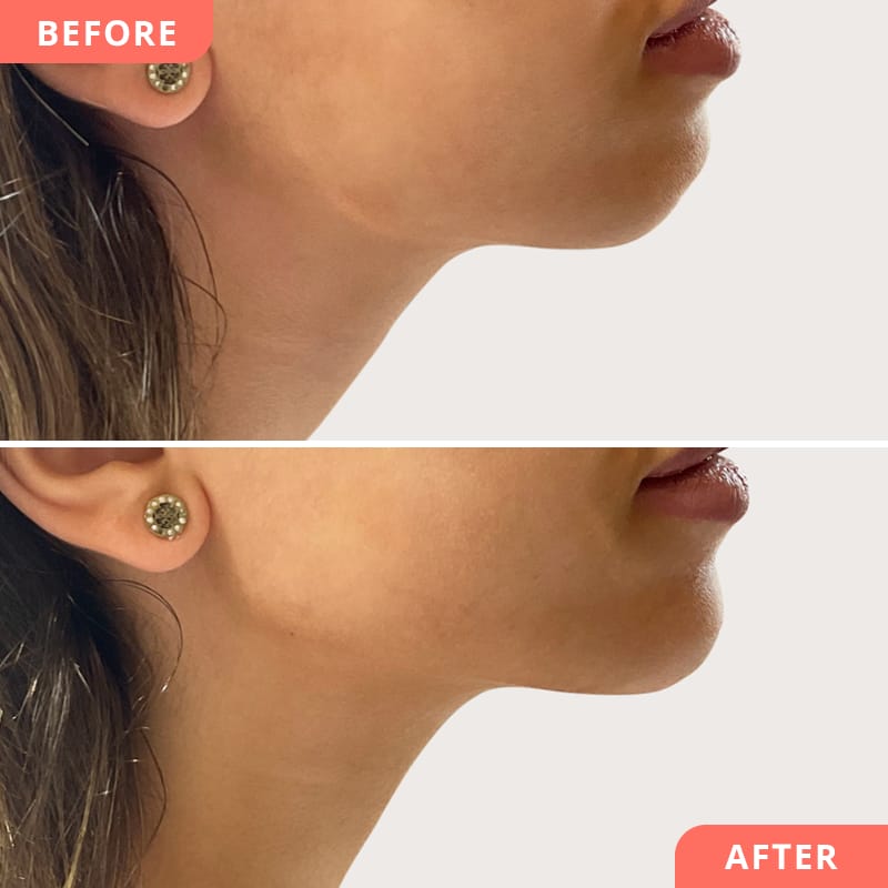 Beauty2Go Vorher-Nachher Bild – Jawline-Behandlung mit Hyaluronsäure für scharfe Gesichtskonturen und natürlich harmonisches Ergebnis
