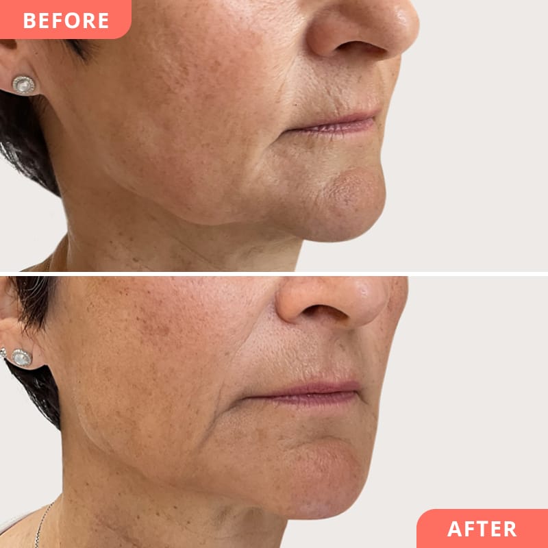 Vorher-Nachher Collage einer Jawline-Korrektur mit Hyaluronsäure – frische Gesichtskontur, Anti-Aging Effekt und Ausgleich von Hängebäckchen