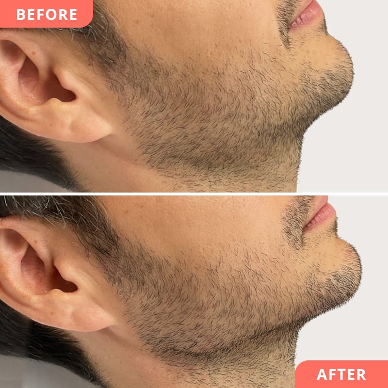 Beauty2Go Vorher-Nachher Bild – Hyaluron-Jawline Aufbau für stärker definierte Kieferpartie und maskulines Gesicht