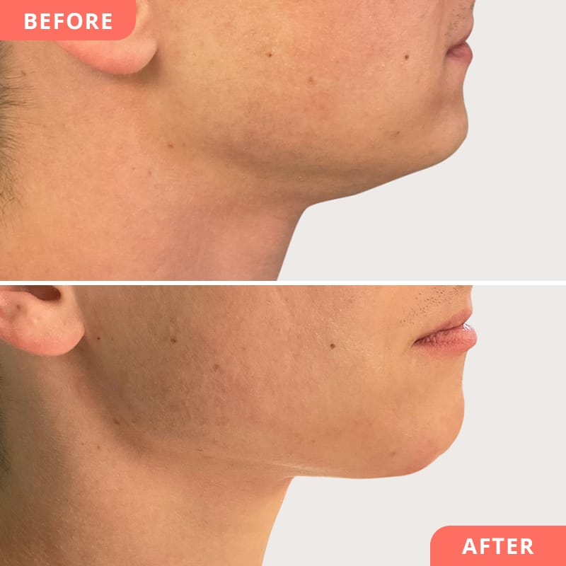 Vorher-Nachher Collage einer Jawline-Behandlung mit Hyaluronsäure bei Beauty2Go – markantere Kieferlinie für maskulinen Look