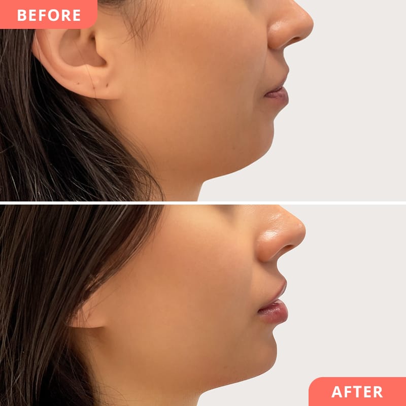 Correction du menton à l'acide hyaluronique chez Beauty2Go - Collage avant/après pour un profil latéral harmonieux et une pointe du menton plus nette