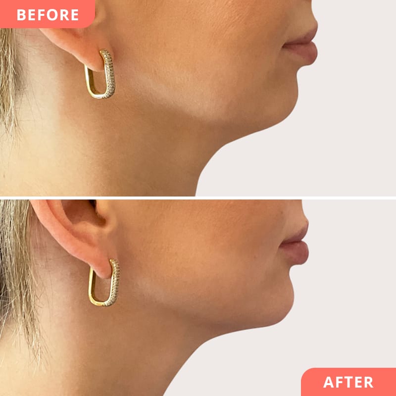 Image avant/après d'une correction du menton Beauty2Go - l'acide hyaluronique permet d'équilibrer la forme du visage et de définir la ligne du menton