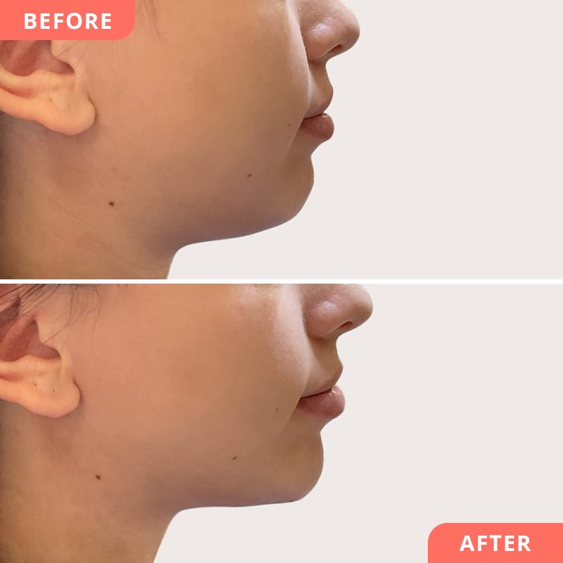 Résultat naturel après une reconstruction du menton à l'acide hyaluronique - collage avant-après pour des proportions du visage affinées