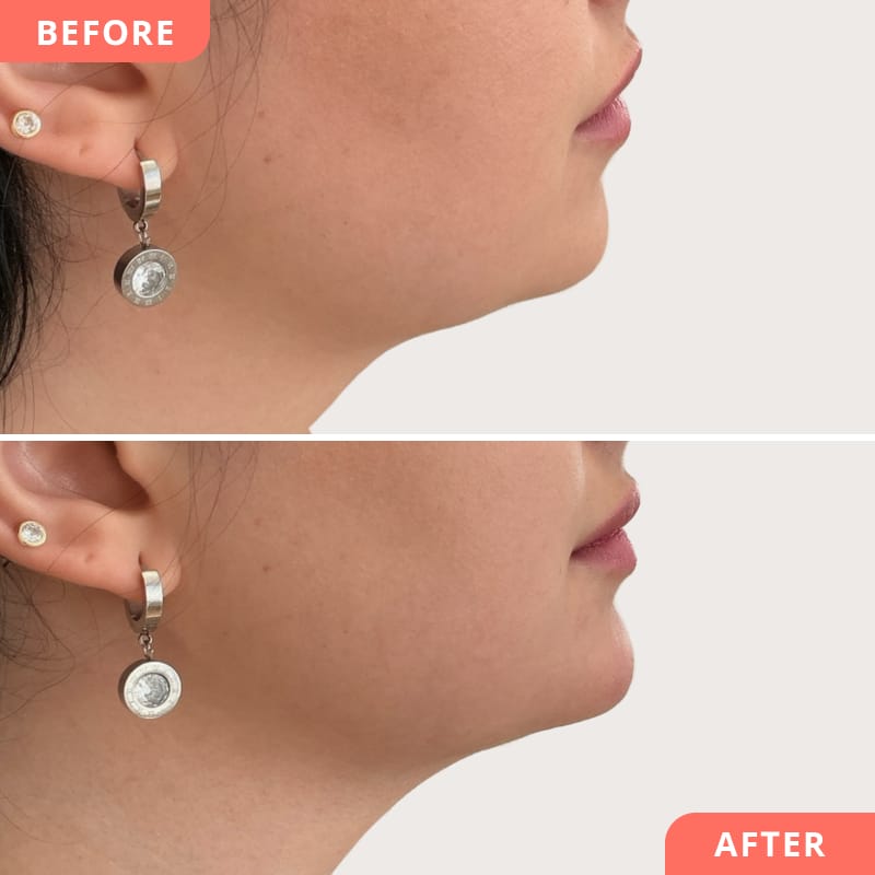 Comparaison avant/après d'une correction du menton à l'acide hyaluronique - Amélioration de la pointe du menton pour un profil harmonieux