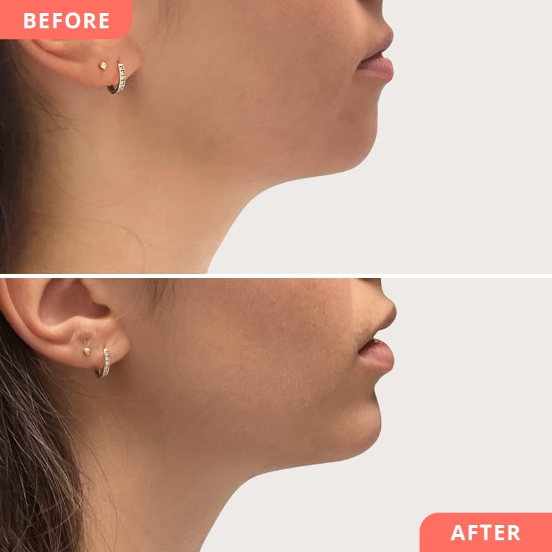 Image Beauty2Go avant/après - Reconstruction du menton à l'acide hyaluronique pour une ligne de menton définie et une forme de visage équilibrée