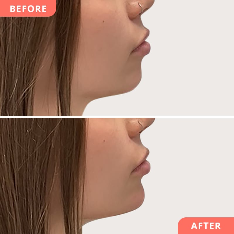 Collage avant/après d'une correction du menton à l'acide hyaluronique chez Beauty2Go - pointe du menton affinée et profil latéral harmonieux