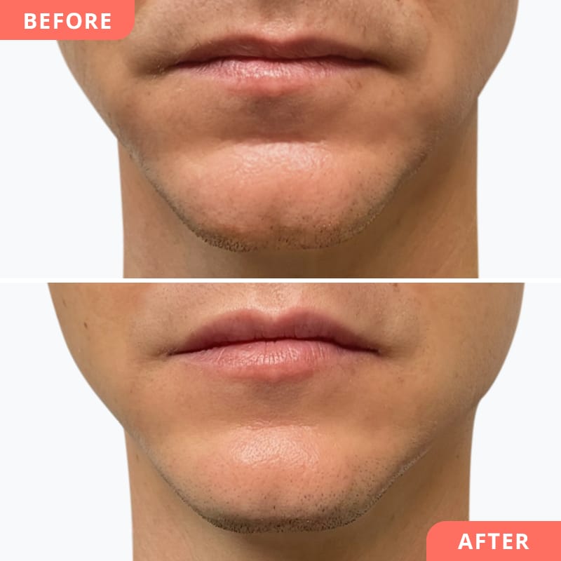 Collage avant/après d'une correction du menton à l'acide hyaluronique chez Beauty2Go - menton plus masculin, mieux défini et plus de symétrie dans le visage