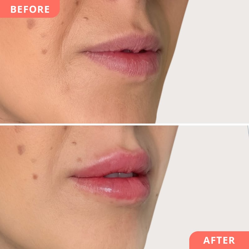 Vorher-Nachher Vergleich einer natürlichen Lippenkorrektur – Hyaluron sorgt für mehr Feuchtigkeit und jugendlich glatte Lippen