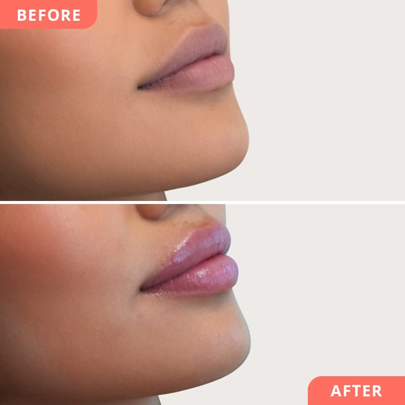 Vorher-Nachher Collage einer Hyaluron-Lippenunterspritzung bei Beauty2Go – voluminöse, pralle Lippen mit modernem Look