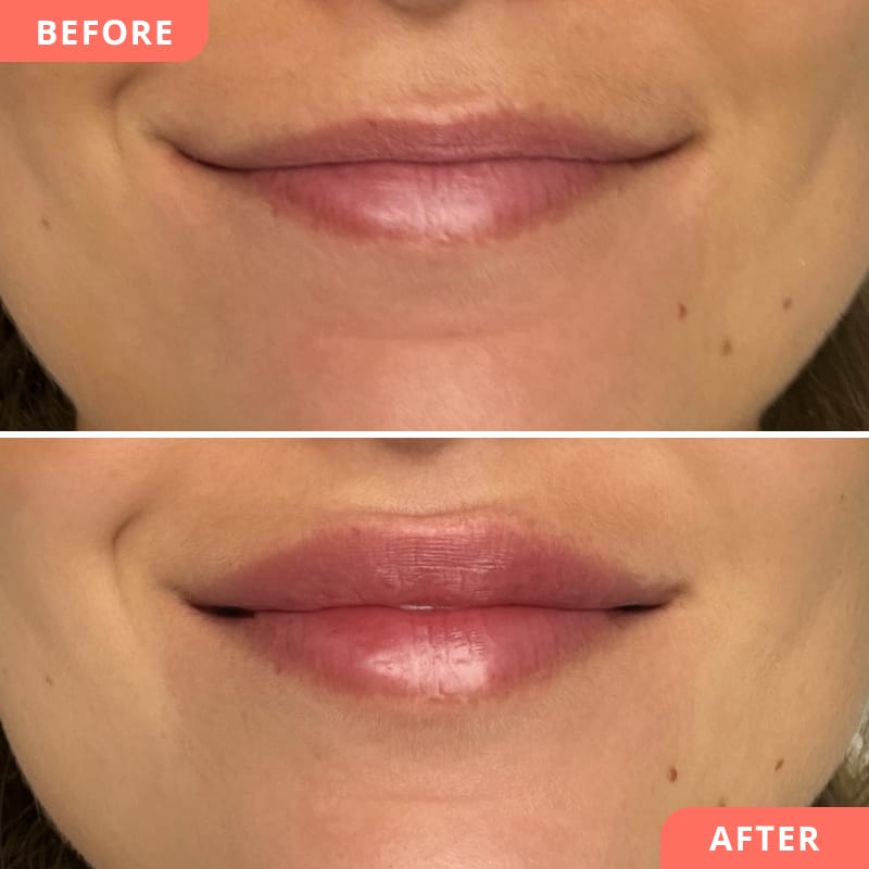 Vorher-Nachher Bild einer Hyaluron-Lippenunterspritzung – sanftes Volumen für harmonisches Verhältnis von Ober- und Unterlippe