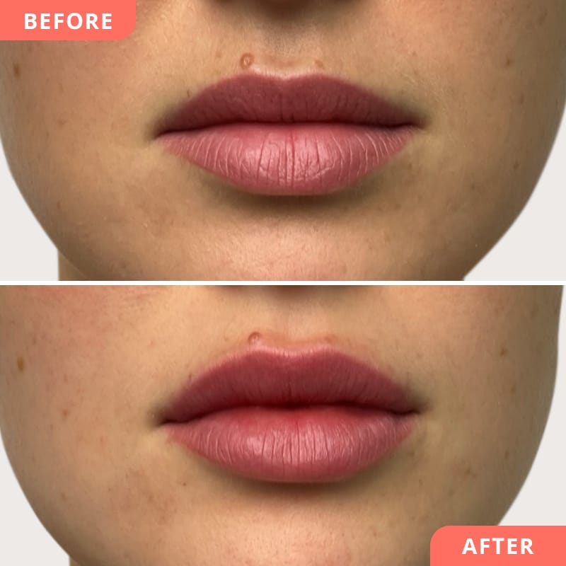 Beauty2Go Vorher-Nachher Collage – Hyaluronsäure sorgt für mehr Symmetrie und natürliche Lippenharmonie