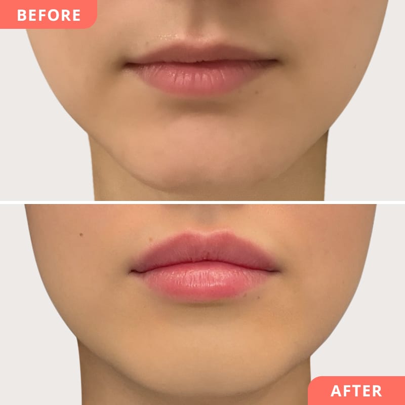Beauty2Go Lippenunterspritzung mit Hyaluronsäure – Vorher-Nachher Collage für definierte Konturen und leichtes Lippenvolumen