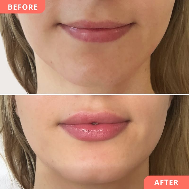 Vorher-Nachher Vergleich einer Lippenunterspritzung mit Hyaluron – dezente Volumenanpassung für ausgeglichene Lippenproportionen