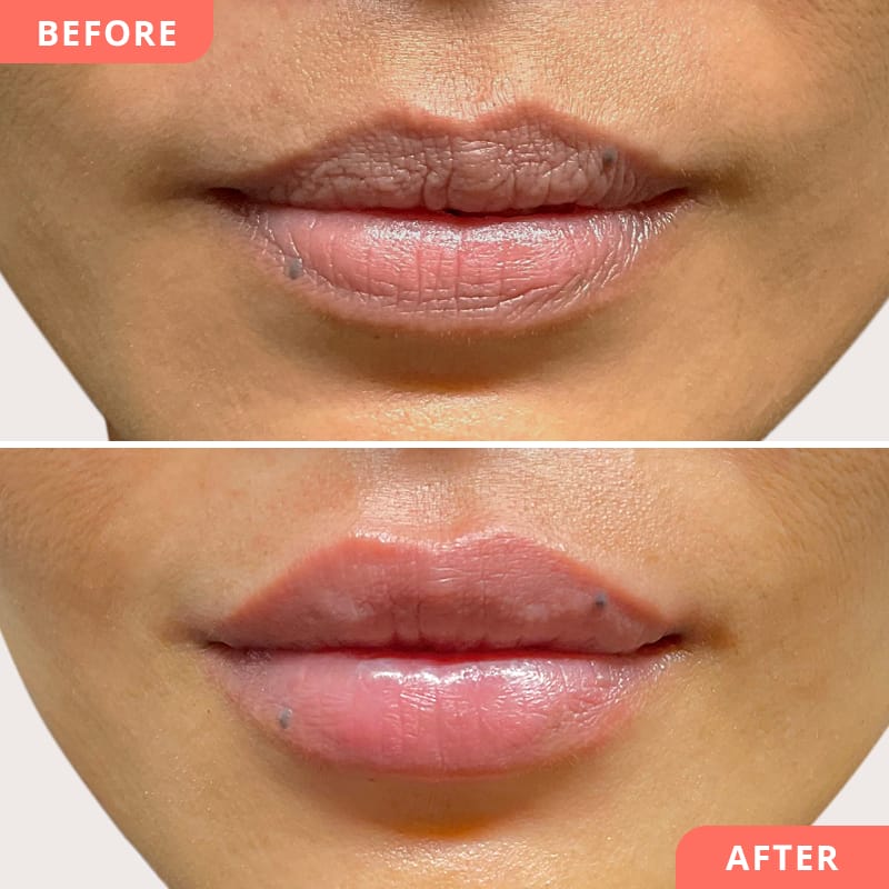 Vorher-Nachher Vergleich einer Lippenunterspritzung mit Hyaluron – deutlich pralleres Volumen und femininer Ausdruck