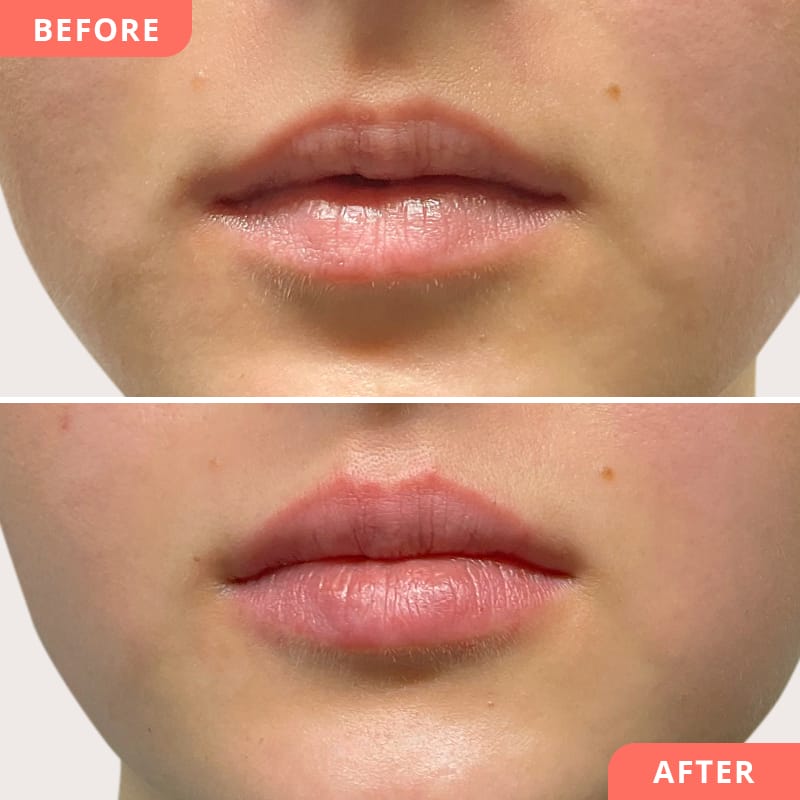 Beauty2Go Vorher-Nachher Collage – Hyaluron-Behandlung für hydratisierte Lippen und sanfte Glättung feiner Fältchen