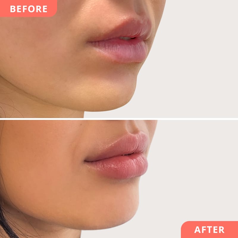 Natürliches Ergebnis nach Lippenunterspritzung mit Hyaluronsäure bei Beauty2Go – frische, hydratisierte Lippen ohne Fältchen