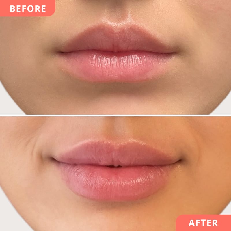 Beauty2Go Vorher-Nachher Bild – Hyaluronsäure-Behandlung für volle Lippen und sinnlichen Kussmund