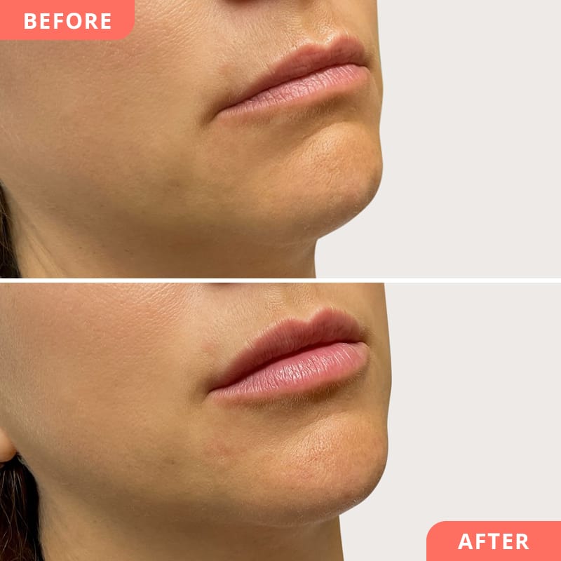 Vorher-Nachher Collage einer Lippenunterspritzung mit Hyaluronsäure bei Beauty2Go – sanftes Volumen und klar definierte Lippenkontur