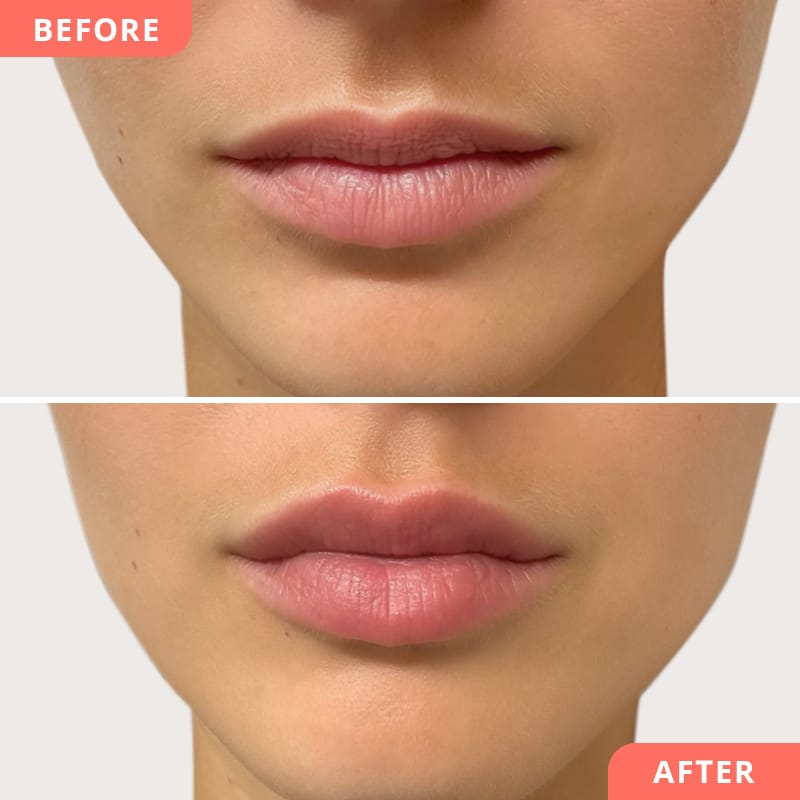 Natürliches Ergebnis nach Lippenunterspritzung – Beauty2Go Vorher-Nachher Collage mit leichtem Volumen und präziser Lippenform
