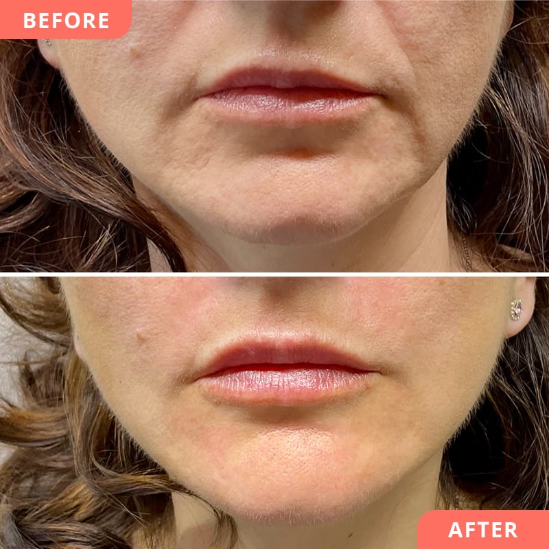 Vorher-Nachher Collage einer Marionettenfalten-Unterspritzung mit Hyaluronsäure bei Beauty2Go – geglättete Falten für jugendlich-frisches Aussehen