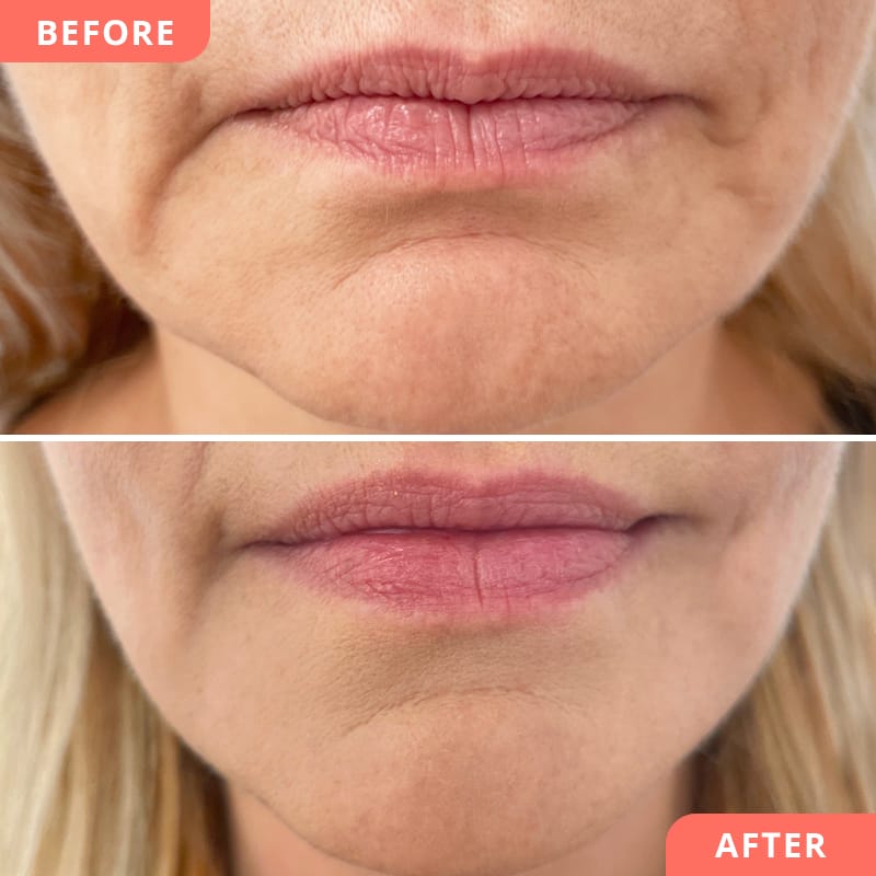 Beauty2Go Vorher-Nachher Bild – Hyaluron-Behandlung der Marionettenfalten für Anti-Aging Effekt und verjüngte Mundpartie
