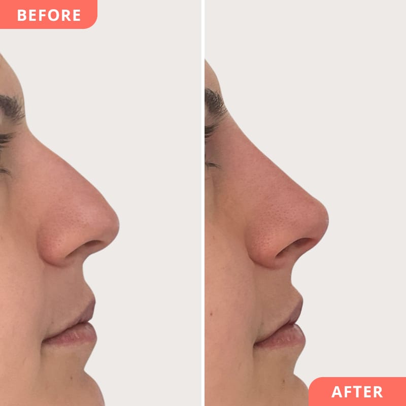 Vorher-Nachher Collage einer Nasenkorrektur mit Hyaluronsäure – Anhebung der Nasenspitze für ein ausgeglichenes Seitenprofil