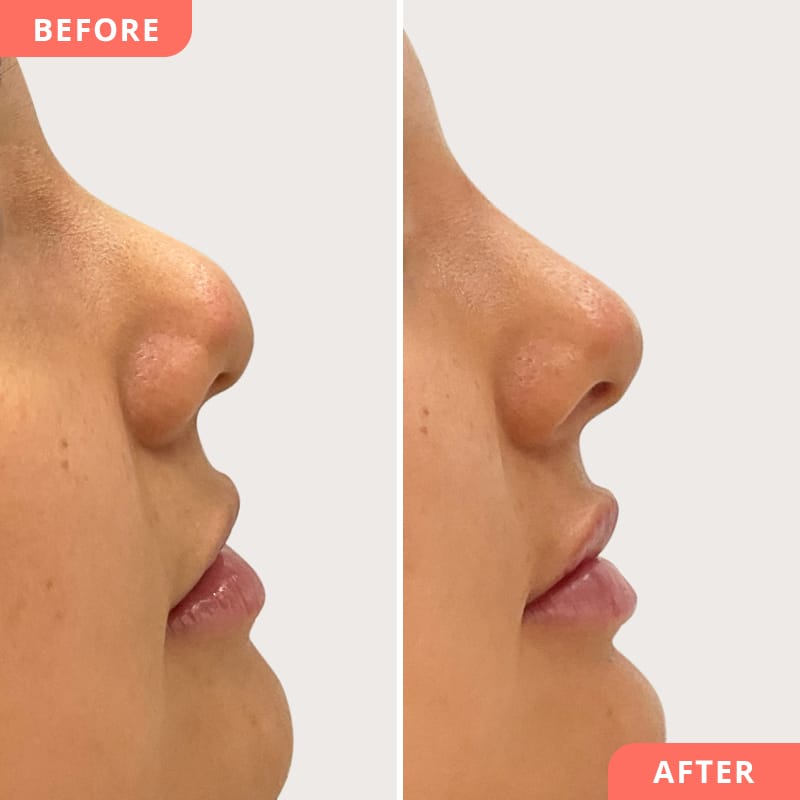 Vorher-Nachher Collage einer Nasenkorrektur mit Hyaluronsäure bei Beauty2Go – verfeinerte Nasenspitze für natürlichen Stupsnasen-Look