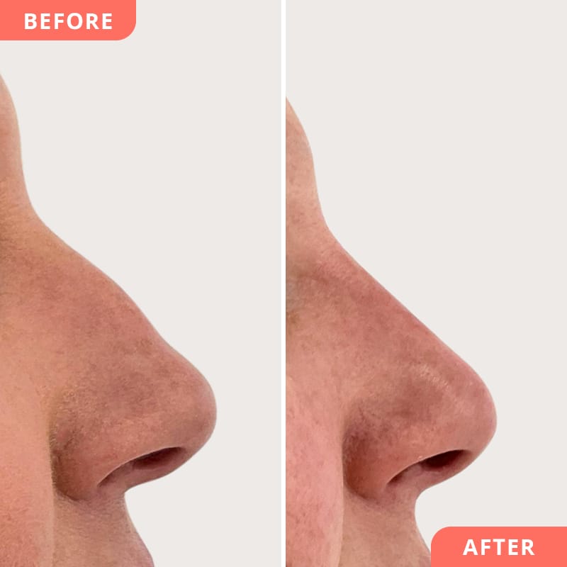 Beauty2Go Vorher-Nachher Bild – Hyaluronsäure-Behandlung korrigiert Nasenhöcker und sorgt für glatte Profil-Linie