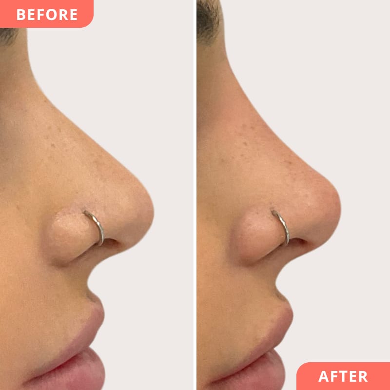 Beauty2Go Vorher-Nachher Bild – Hyaluron-Behandlung für eine elegante Nasenspitze und harmonischen Tinkerbell-Nose Effekt