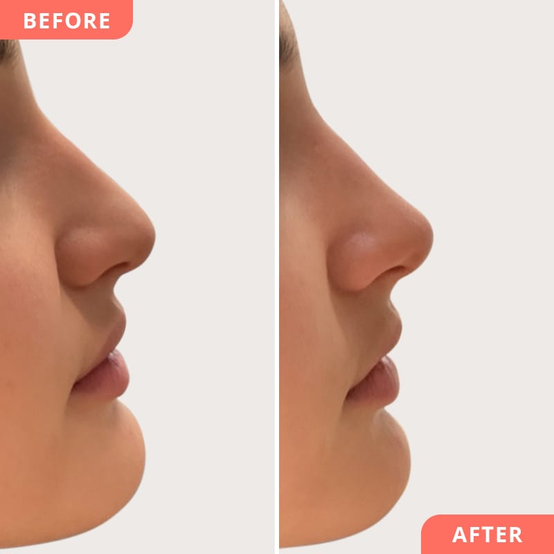 Vorher-Nachher Vergleich einer Hyaluronsäure-Nasenkorrektur – Nasenspitze angehoben für jugendlichen und femininen Ausdruck