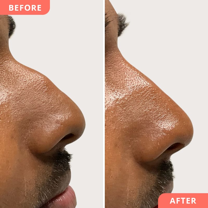 Vorher-Nachher Collage einer minimal-invasiven Nasenkorrektur mit Hyaluron – Ausgleich von Nasenhöckern ohne Operation