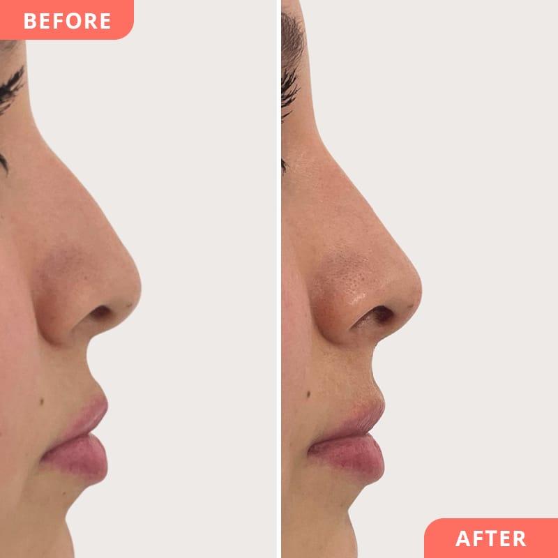 Beauty2Go Vorher-Nachher Bild – Hyaluron-Behandlung sorgt für harmonischen Nasenverlauf und ausgewogenes Profil